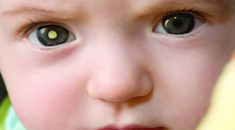 تومور چشم در کودکان